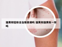 雄黄和轻粉合治银屑病吗 雄黄和雄黄粉一样吗