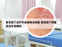 紫花地丁治疗牛皮癣用法用量 紫花地丁抑菌膏治牛皮癣吗