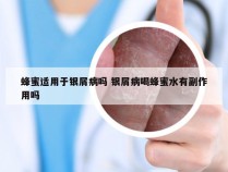 蜂蜜适用于银屑病吗 银屑病喝蜂蜜水有副作用吗