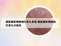 银屑病生物制剂打多久多钱 银屑病生物制剂打多久才有效
