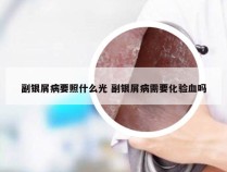 副银屑病要照什么光 副银屑病需要化验血吗