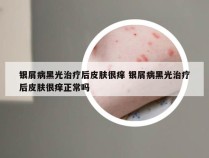 银屑病黑光治疗后皮肤很痒 银屑病黑光治疗后皮肤很痒正常吗