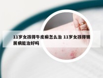 11岁女孩得牛皮癣怎么治 11岁女孩得银屑病能治好吗