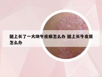 腿上长了一大块牛皮癣怎么办 腿上长牛皮屑怎么办