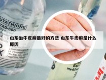 山东治牛皮癣最好的方法 山东牛皮癣是什么原因
