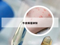 牛皮癣是缺钛