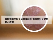 银屑病治疗好了又变荨麻疹 银屑病好了之后起小疙瘩