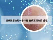 百癣夏塔热片一个疗程 百癣夏塔热片 疗程