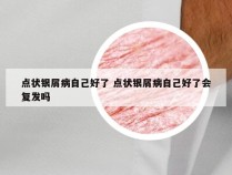 点状银屑病自己好了 点状银屑病自己好了会复发吗