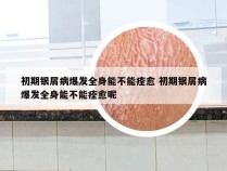 初期银屑病爆发全身能不能痊愈 初期银屑病爆发全身能不能痊愈呢