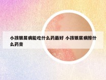 小孩银屑病能吃什么药最好 小孩银屑病擦什么药膏