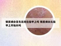银屑病会首先出现在指甲上吗 银屑病会从指甲上开始长吗