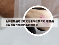 龟头银屑病可以用复方氟米松软膏吗 银屑病可以用复方醋酸地塞米松乳膏