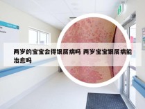 两岁的宝宝会得银屑病吗 两岁宝宝银屑病能治愈吗