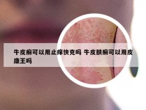 牛皮癣可以用止痒快克吗 牛皮肤癣可以用皮康王吗