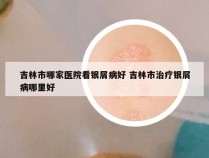 吉林市哪家医院看银屑病好 吉林市治疗银屑病哪里好