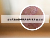 结核实验会影响银屑病吗 银屑病 结核