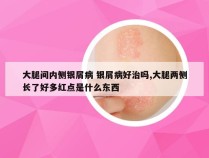 大腿间内侧银屑病 银屑病好治吗,大腿两侧长了好多红点是什么东西