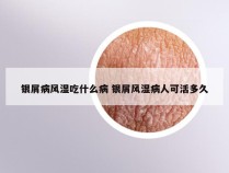 银屑病风湿吃什么病 银屑风湿病人可活多久