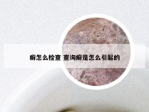癣怎么检查 查询癣是怎么引起的