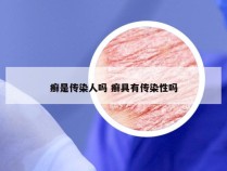癣是传染人吗 癣具有传染性吗