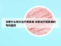 合肥什么地方治疗银屑病 合肥治疗银屑病的专科医院