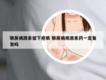 银屑病激素留下疤痕 银屑病用激素药一定复发吗