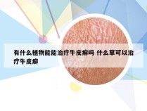 有什么植物能能治疗牛皮癣吗 什么草可以治疗牛皮癣