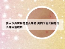 男人下身有癣是怎么来的 男的下面长癣是什么原因造成的