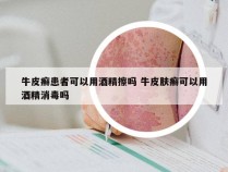 牛皮癣患者可以用酒精擦吗 牛皮肤癣可以用酒精消毒吗