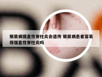 银屑病强直性脊柱炎会遗传 银屑病患者容易得强直性脊柱炎吗