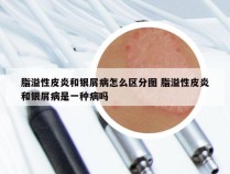 脂溢性皮炎和银屑病怎么区分图 脂溢性皮炎和银屑病是一种病吗