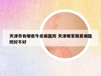 天津市有哪些牛皮癣医院 天津哪家银屑病医院好不好