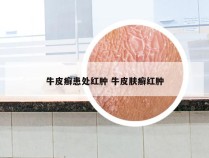 牛皮癣患处红肿 牛皮肤癣红肿