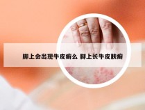 脚上会出现牛皮癣么 脚上长牛皮肤癣