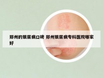 郑州的银屑病口碑 郑州银屑病专科医院哪家好