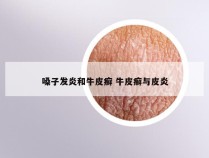 嗓子发炎和牛皮癣 牛皮癣与皮炎