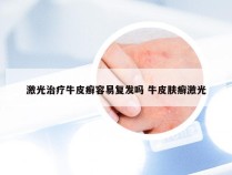 激光治疗牛皮癣容易复发吗 牛皮肤癣激光