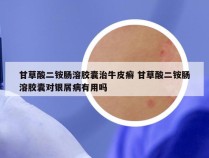 甘草酸二铵肠溶胶囊治牛皮癣 甘草酸二铵肠溶胶囊对银屑病有用吗