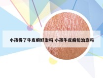 小孩得了牛皮癣好治吗 小孩牛皮癣能治愈吗