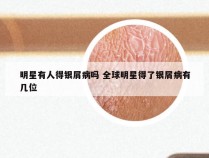 明星有人得银屑病吗 全球明星得了银屑病有几位