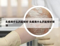 头癣用什么药能擦好 头癣用什么药能擦好得快