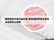 银屑病治疗后又起红斑 银屑病好转后又有红点还痒怎么回事