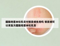 醋酸地塞米松乳膏对银屑病有用吗 银屑病可以用复方醋酸地塞米松乳膏