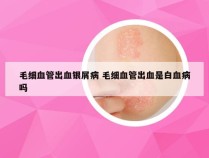 毛细血管出血银屑病 毛细血管出血是白血病吗