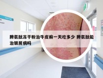 脾氨肽冻干粉治牛皮癣一天吃多少 脾氨肽能治银屑病吗