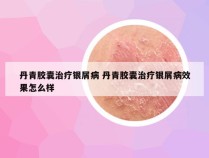 丹青胶囊治疗银屑病 丹青胶囊治疗银屑病效果怎么样