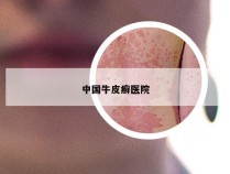 中国牛皮癣医院