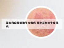 花椒和白醋能治牛皮癣吗 醋泡花椒治牛皮屑吗