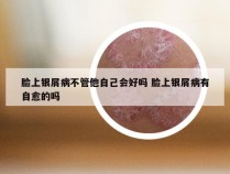 脸上银屑病不管他自己会好吗 脸上银屑病有自愈的吗